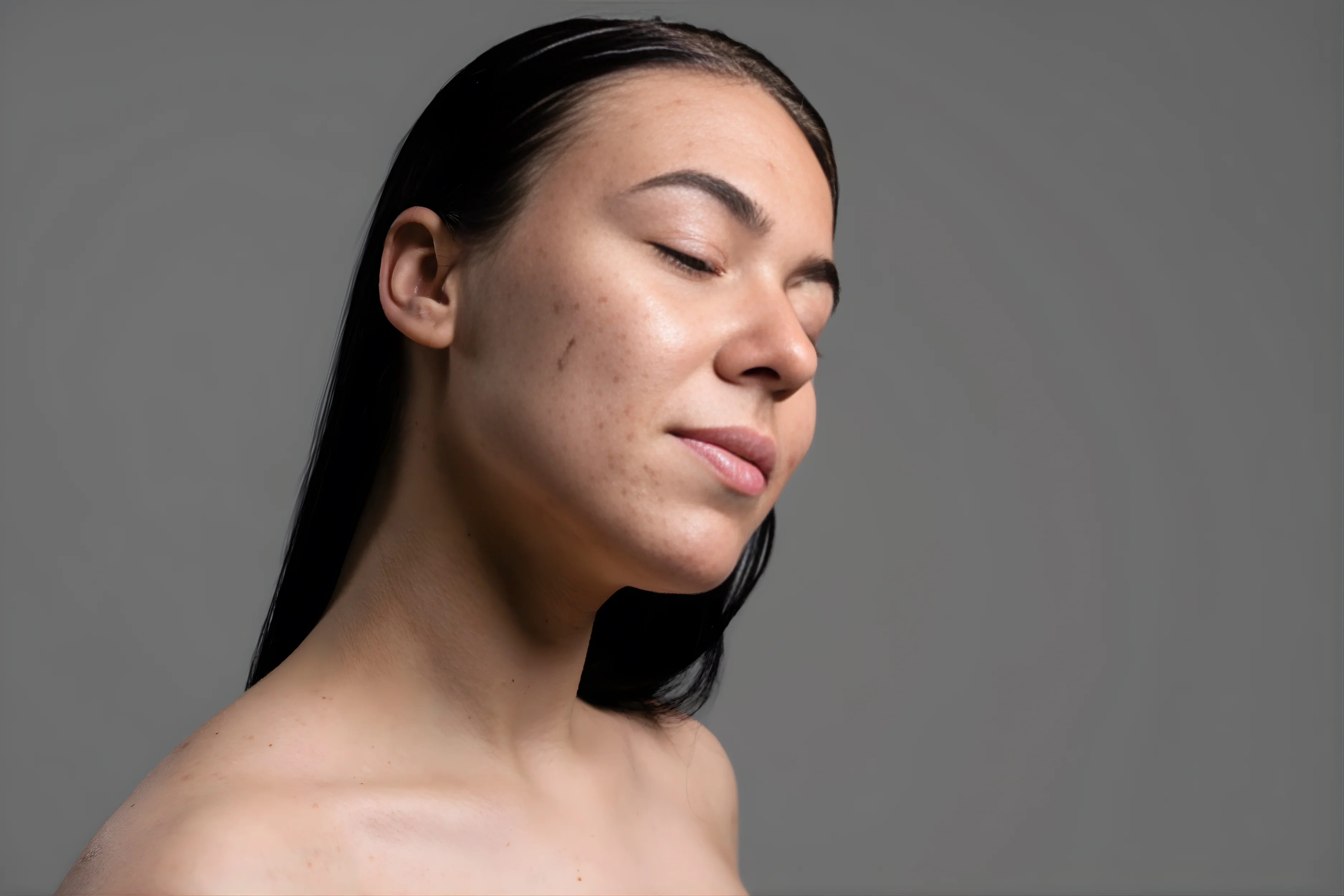 Acne & Acne Scar